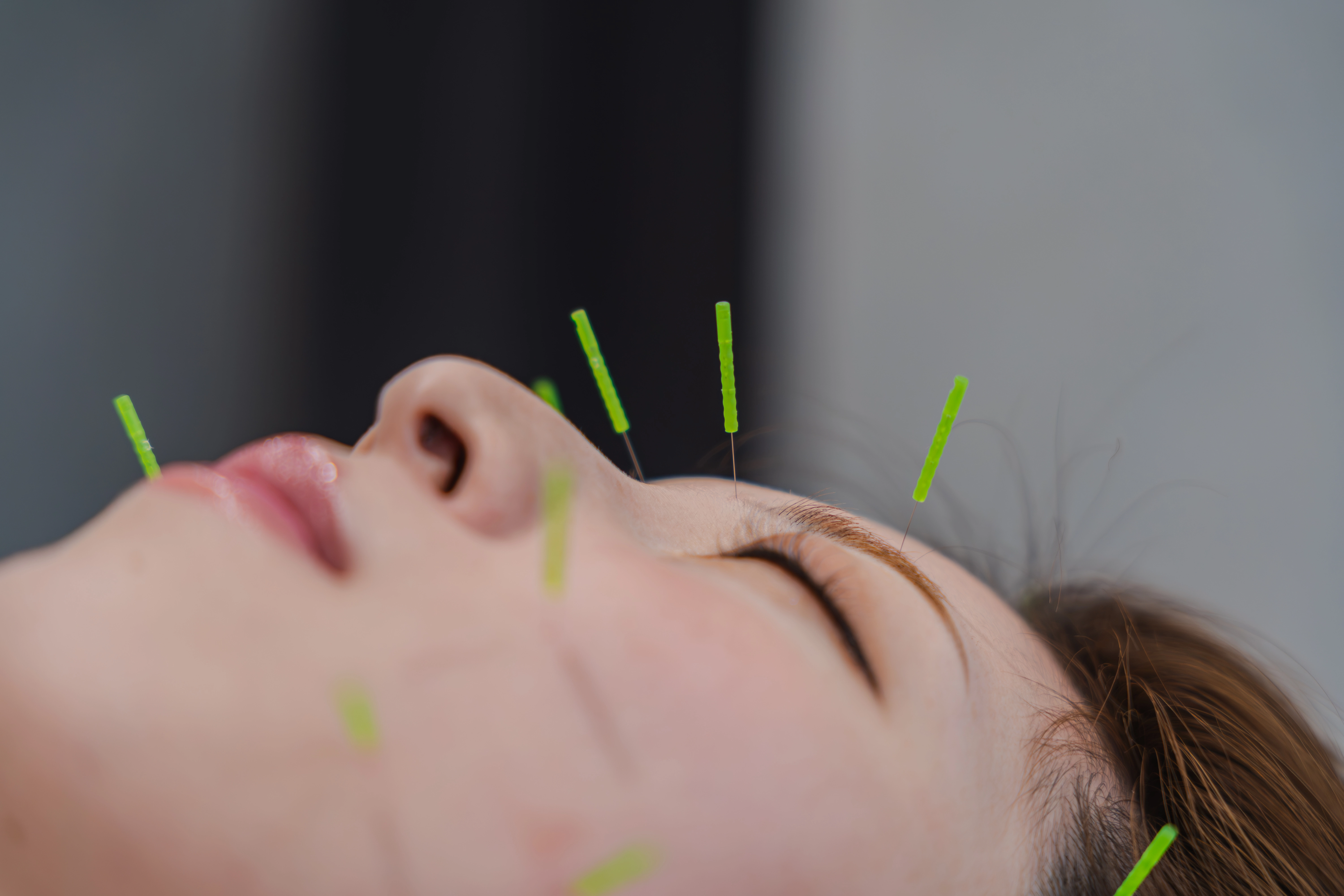 MITONOU式 フェイスライン美容鍼